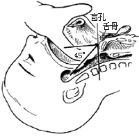甲状腺舌管囊肿（瘘）切除术图片