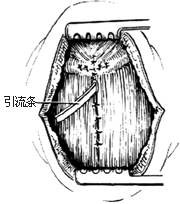 甲状腺舌管囊肿（瘘）切除术图片