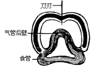 气管切开术图片