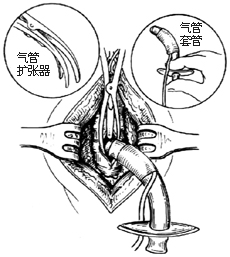 气管切开术图片