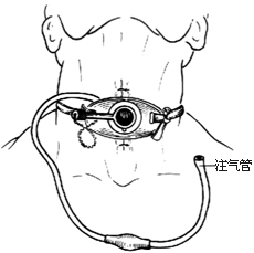 气管切开术图片