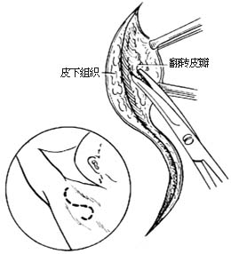 腋臭手术图片