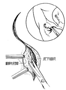 腋臭手术图片