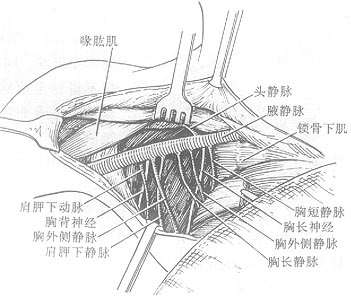 乳癌根治术图片