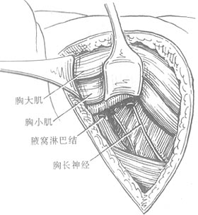 乳癌简化根治术图片