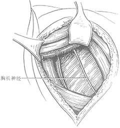 乳癌简化根治术图片