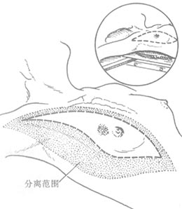 乳癌根治术图片