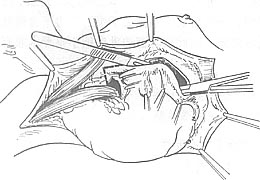 乳癌扩大根治术图片