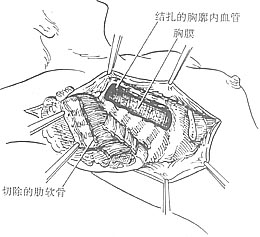 乳癌扩大根治术图片