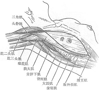 乳癌根治术图片