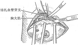 乳房单纯切除术图片