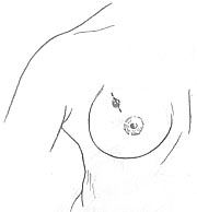 乳房良性肿瘤切除术图片