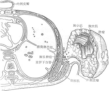 乳癌手术图片