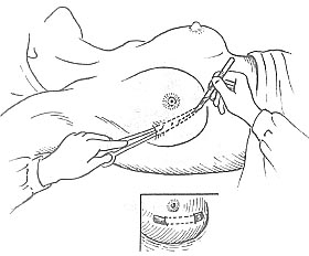 乳房脓肿切开引流术图片