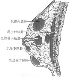 乳房脓肿切开引流术图片