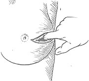 乳房脓肿切开引流术图片