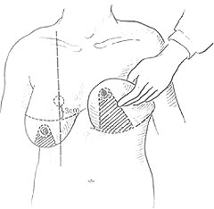 乳房缩小整形术图片