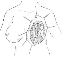 乳房缩小整形术图片