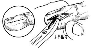 脓性指头炎切开引流术图片