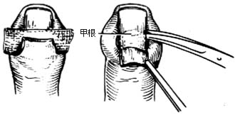 甲沟炎切开引流术图片