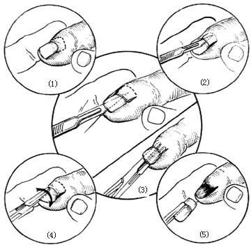 甲下积脓拔甲术图片