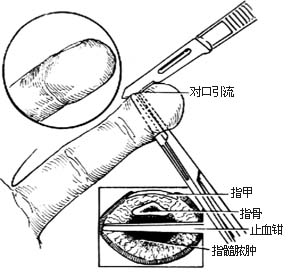 脓性指头炎切开引流术图片