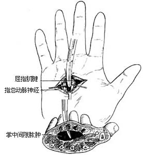 掌中间隙脓肿切开引流术图片