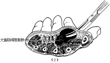 大鱼际间隙脓肿切开引流术图片