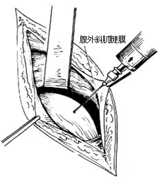 髂窝脓肿切开引流术图片