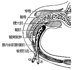 髂窝脓肿切开引流术图片