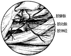 深脓肿切开引流术图片