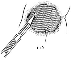 新生儿皮下坏疽切开引流术图片