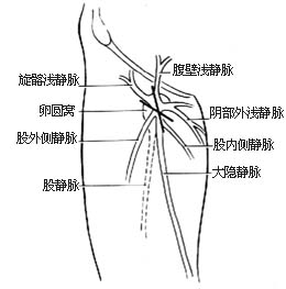 大隐静脉高位结扎、剥脱术图片