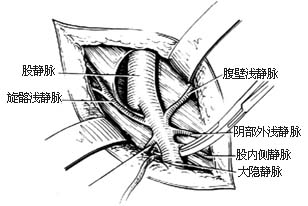 大隐静脉高位结扎、剥脱术图片