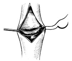 下肢深静脉原发性瓣膜功能不全手术图片