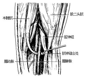 下肢深静脉原发性瓣膜功能不全手术图片
