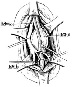 外伤性动脉瘤修复性手术图片