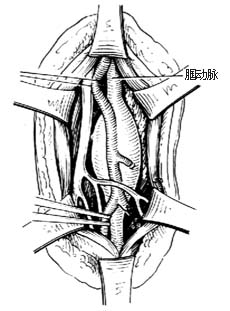 外伤性动脉瘤修复性手术图片