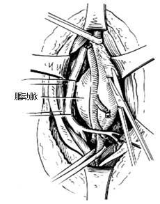 外伤性动脉瘤修复性手术图片