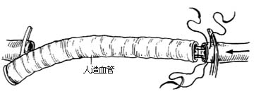 外伤性动脉瘤修复性手术图片