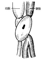 外伤性动静脉瘘闭塞性手术图片