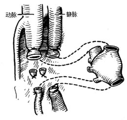 外伤性动静脉瘘闭塞性手术图片