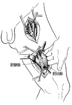 外伤性动静脉瘘修复性手术图片