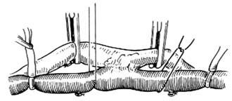 外伤性动静脉瘘修复性手术图片