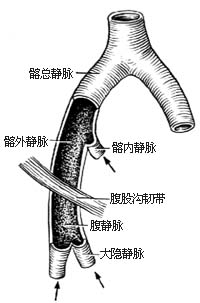 髂、股静脉血栓摘除术图片