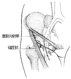 髂、股静脉血栓摘除术图片