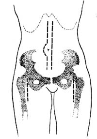 经腹部途径腹主动脉分叉处血栓摘除术图片