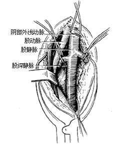 髂、股静脉血栓摘除术图片