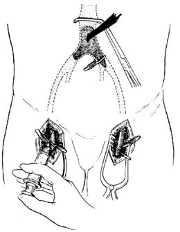 经腹部途径腹主动脉分叉处血栓摘除术图片