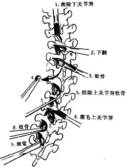 Harrington手术图片